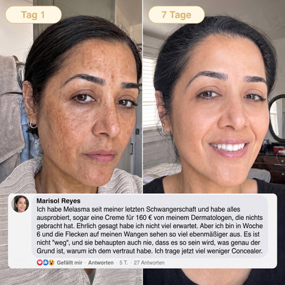 Neu! ✨ Hiskin® Kurkuma × Kojisäure Overnight Peel-Off-Maske – Mildert hartnäckige Pigmentflecken & glättet sichtbare Falten über Nacht 🌙✨ Kurkuma × Kojisäure × Peptid ✅ Nur ein Schritt pro Nacht · Sichtbare Ergebnisse nach 7 Nächten